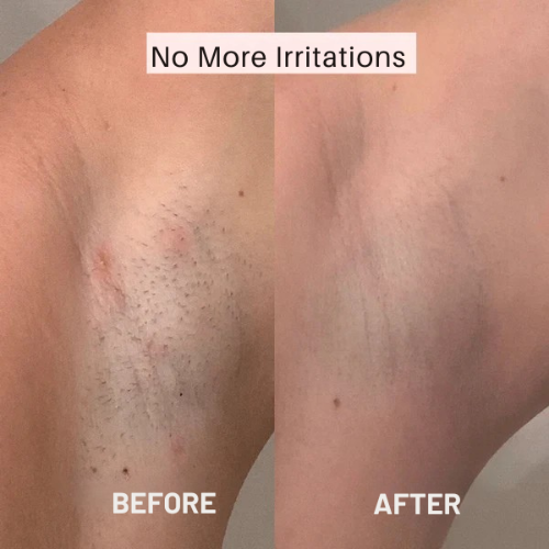 Hårklipper for kvinner – Glatt hud uten irritasjon 